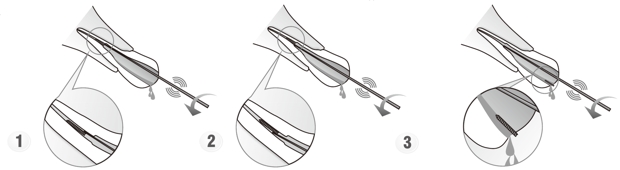 Сфера применения наконечника для скалера